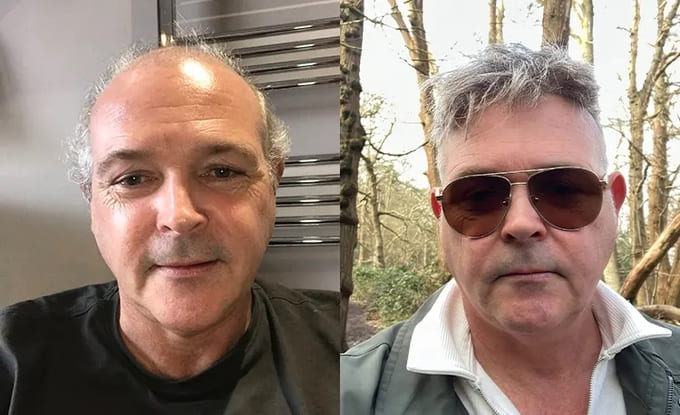 Champion men's hairpiece before and after