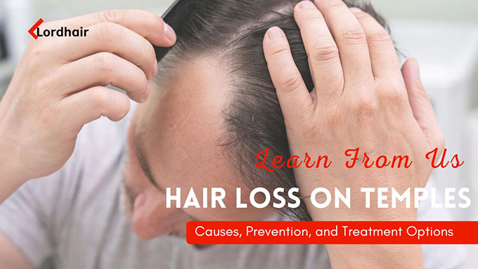 temple hair loss cover