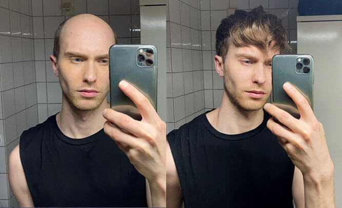 Juha Lordhair hair system before and after
