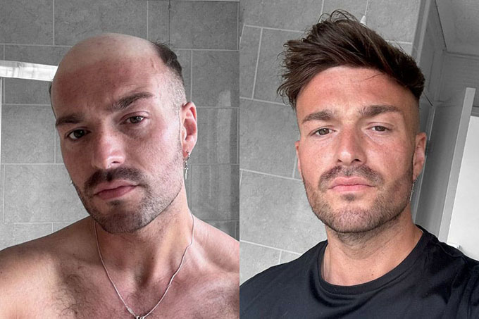 Lordhair hair replacement system before & after