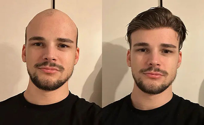 Lordhair hair system before and after