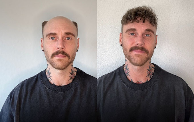 Lordhair hair system before and after