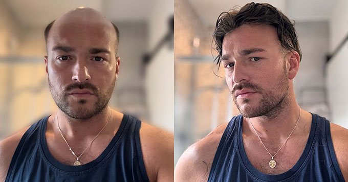 Lordhair hair systems before and after