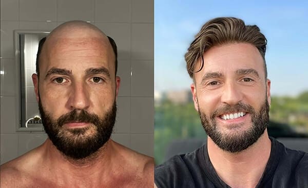 Lordhair toupee before and after