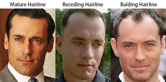 Mature Hairline vs Receding Hairline vs Balding Hairline