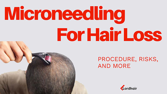 Microneedling for hair loss