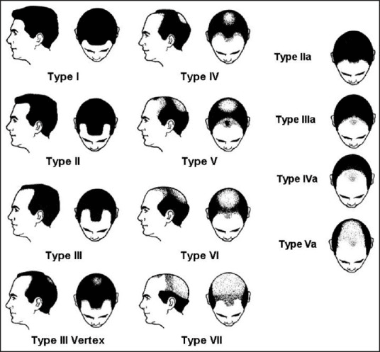 Norwood Scale Hair Loss Stages