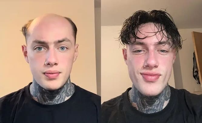 UTS 2.0 thinl skin hair system before and after