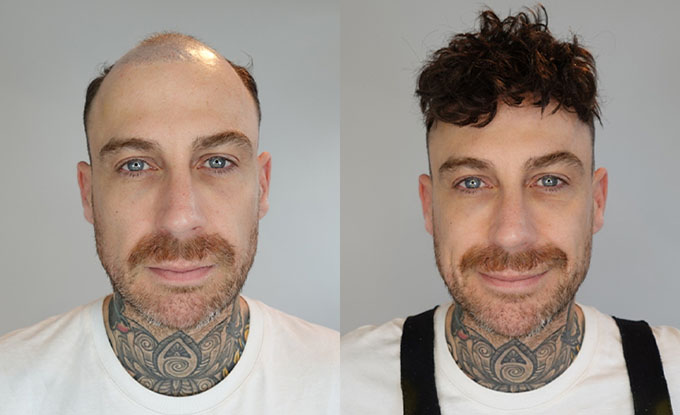 champion hair system before and after