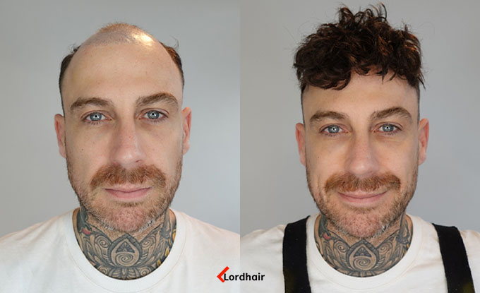 champion hair system before and after