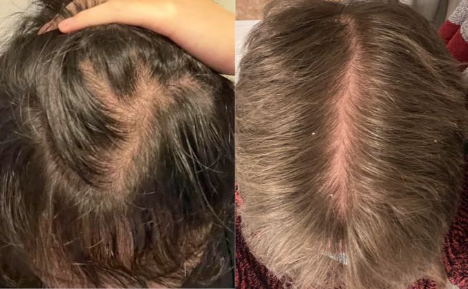 examples of diffuse thinning