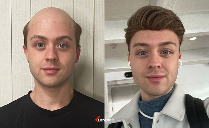 neo before and after