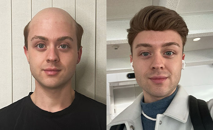 neo hair system before and after