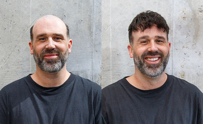 superskin-v hair system before and after