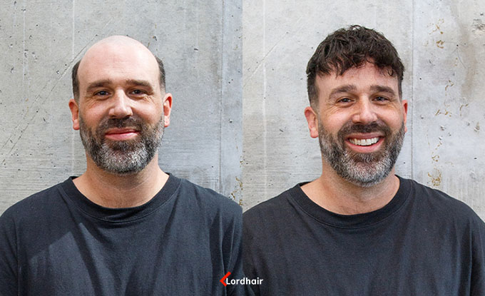 superskin v before and after