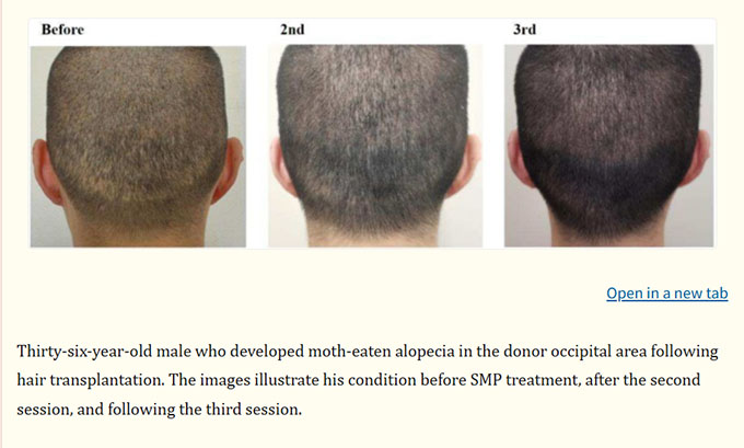 Scalp Micropigmentation