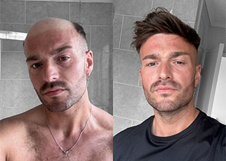 lordhair before and after