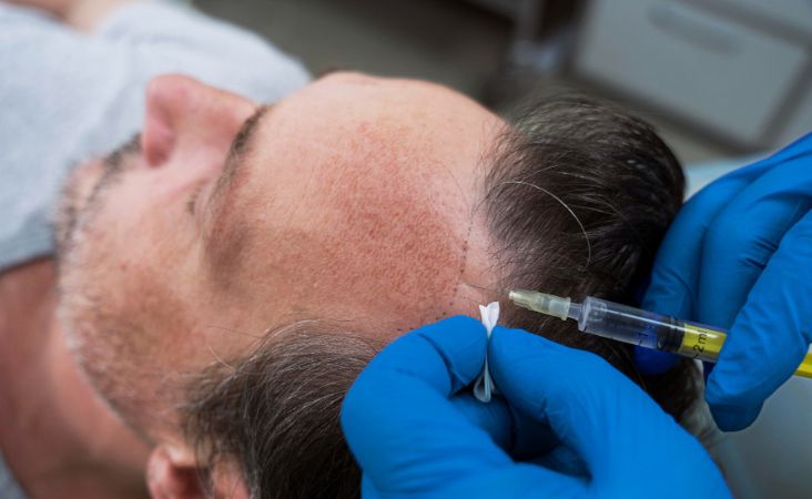 hair transplant