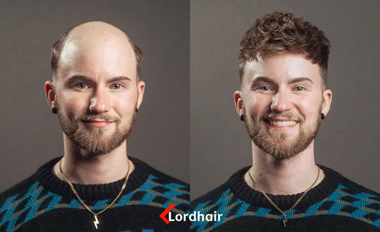 Lordhair hair system before & after