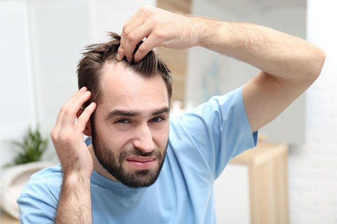 man with receding hairline