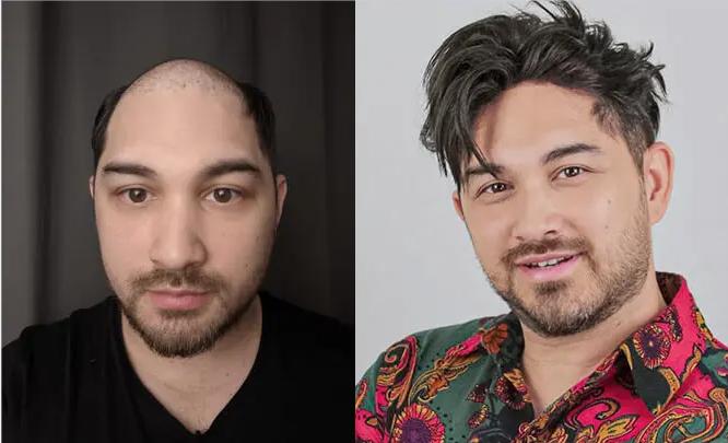 Medium Textured Hair with Hair Systems