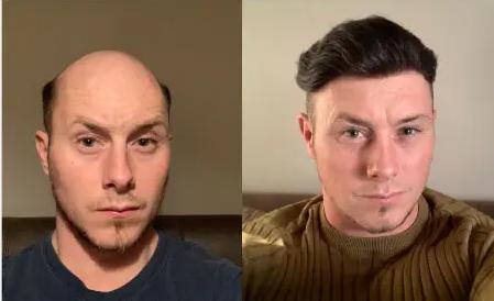 Undercut Haircut with Hair System