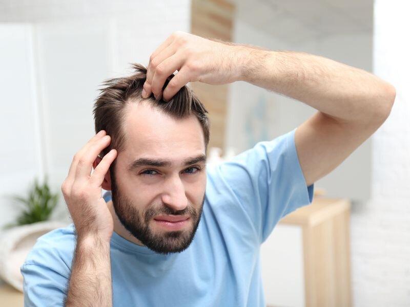 receding hairline