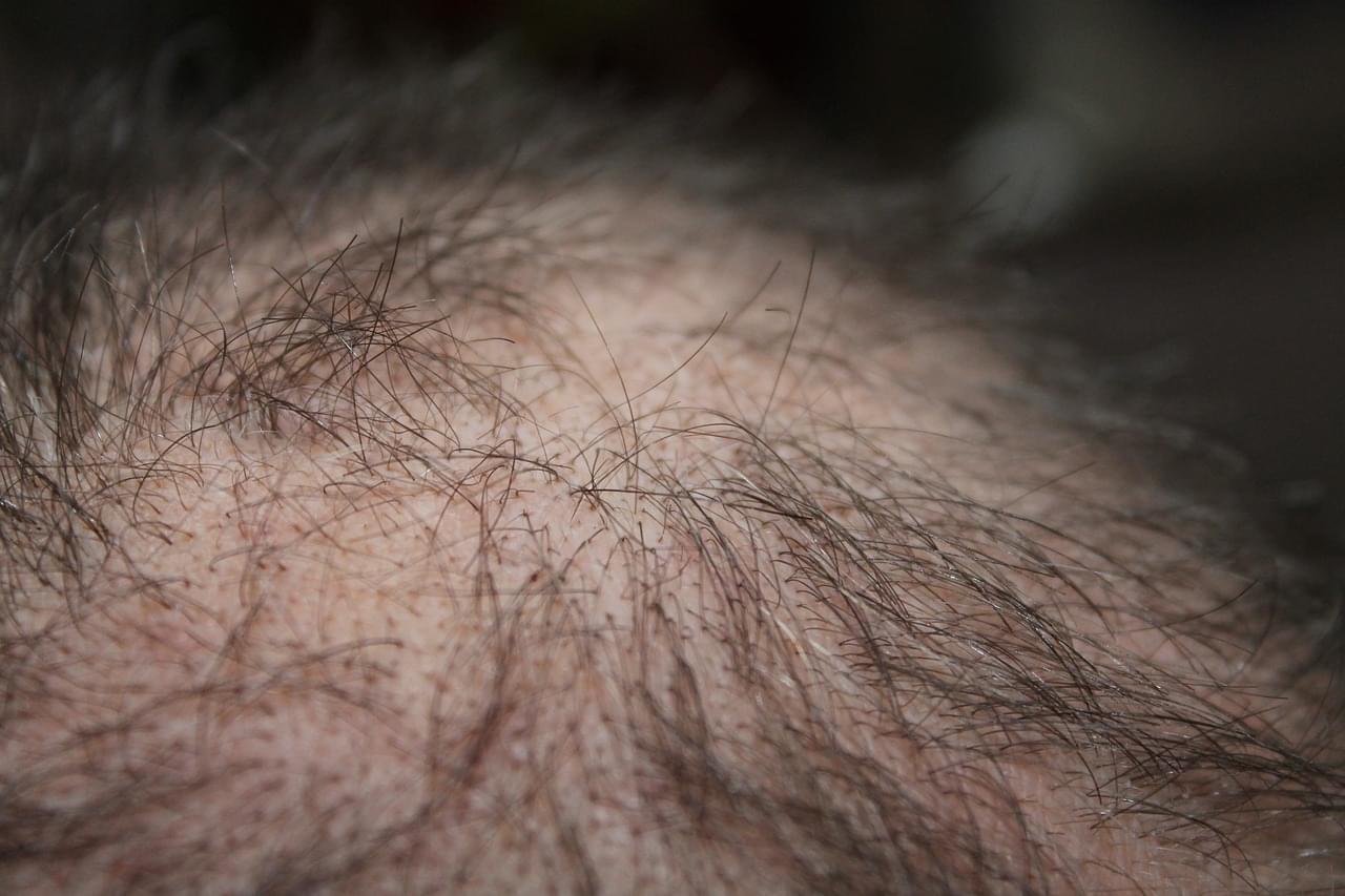 thinning hair