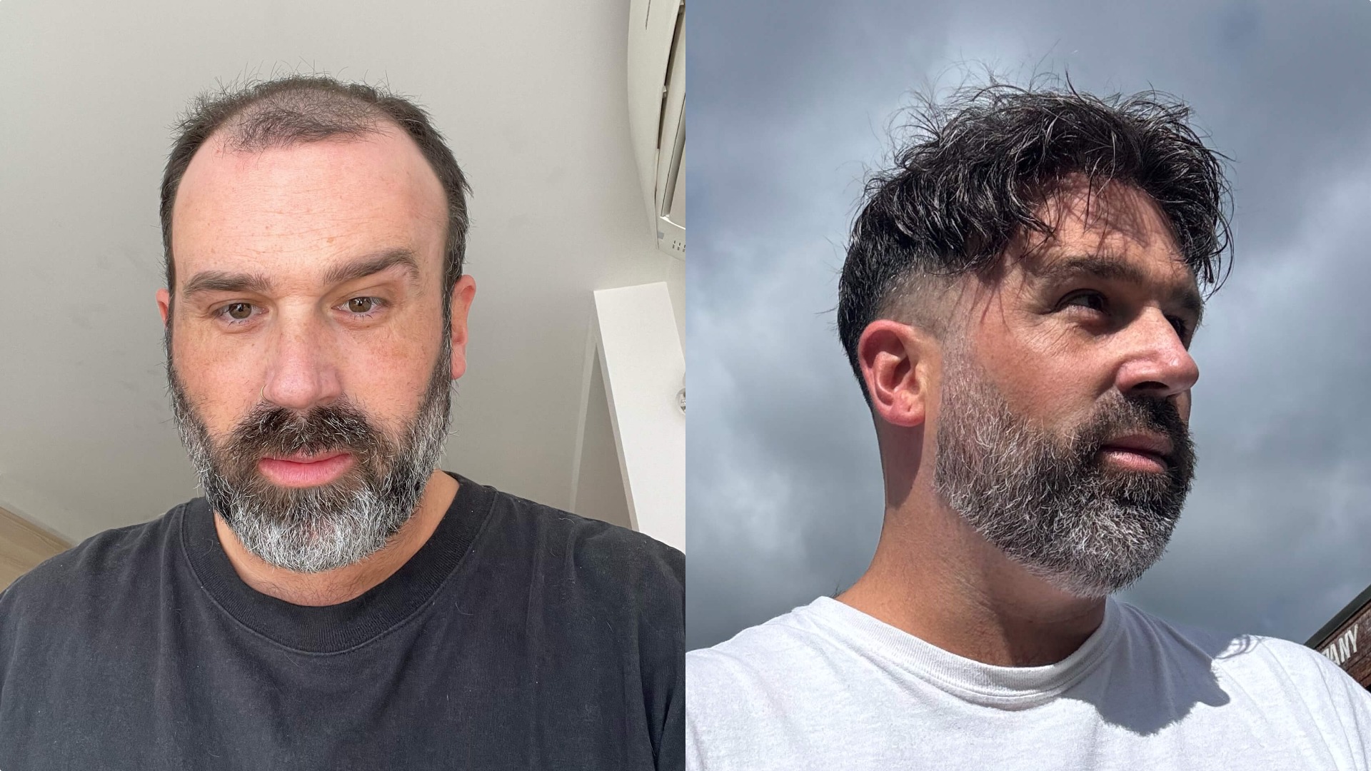 Before and after appearance with the thin skin hair system