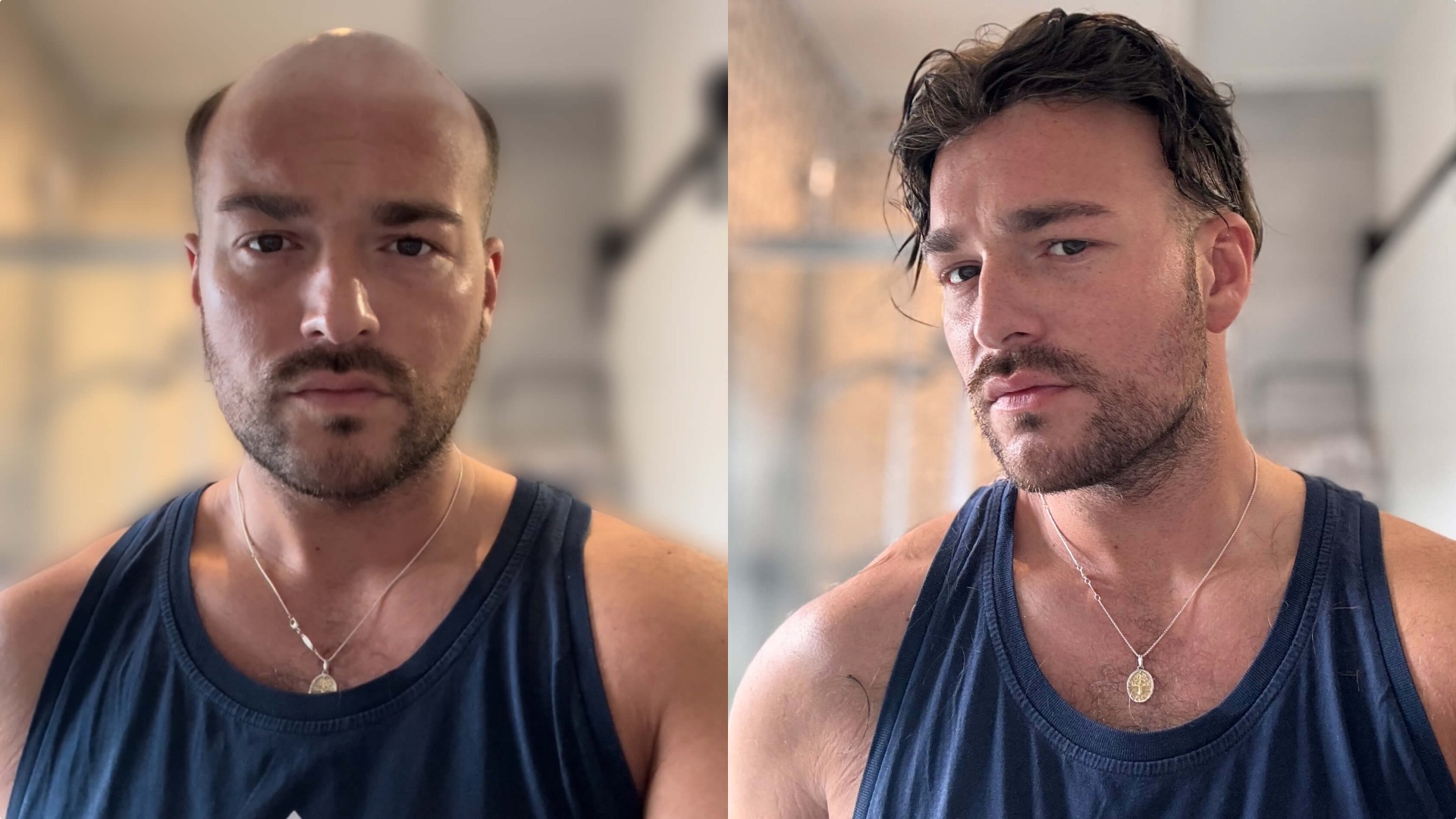 Before and after appearance with the lace hair system