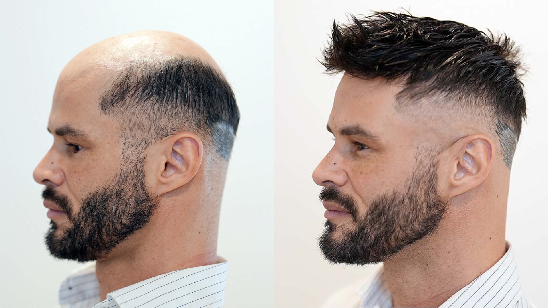 Personalize Mono Hair System
