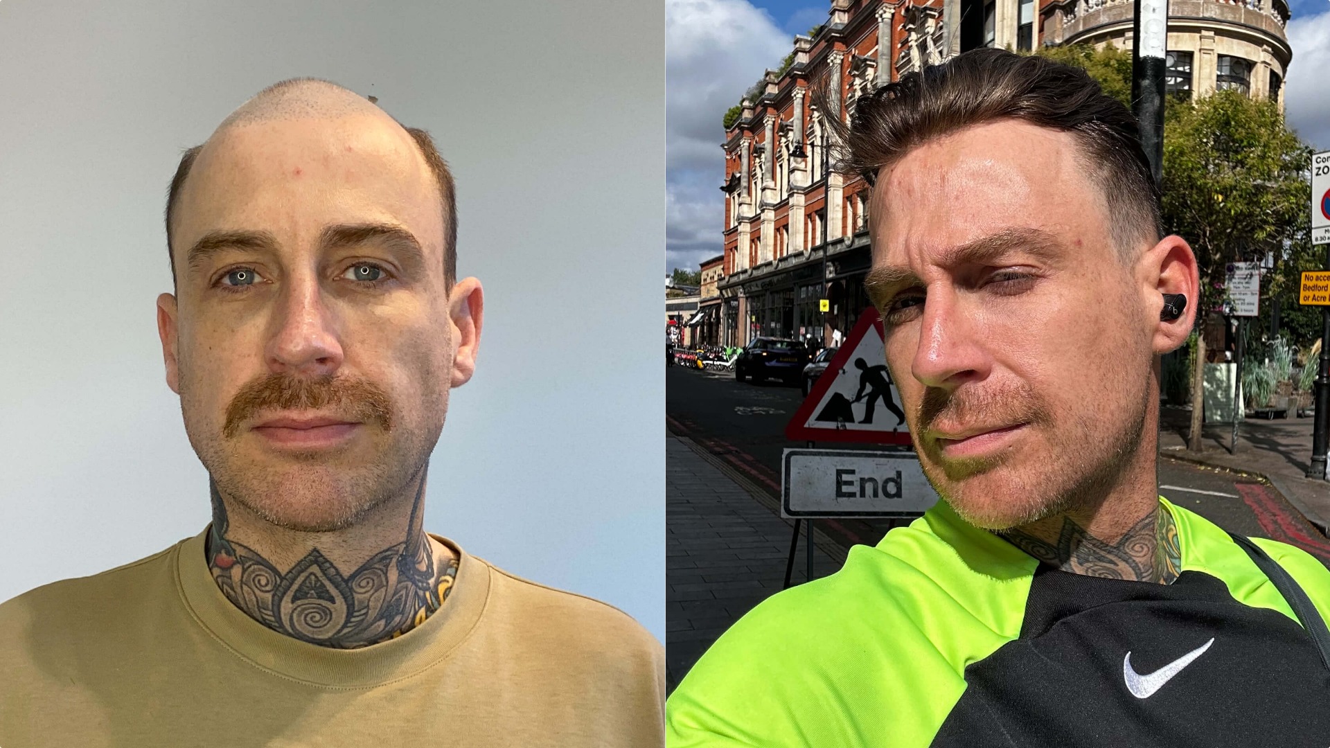 Before and after appearance with the lace hair system