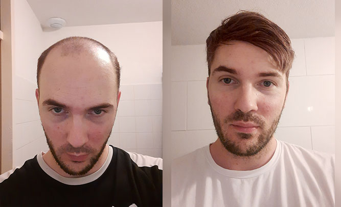 Before & after toupee for men