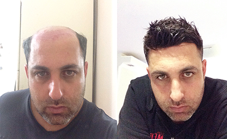 Customers Photos Of Non Surgical Hair Replacement Systems