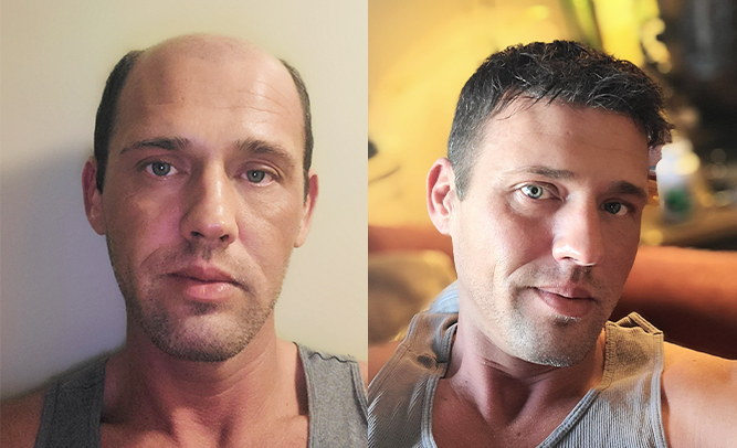 hair system before & after