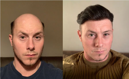 Hair System Before And After Photos Hairpiece Transformation