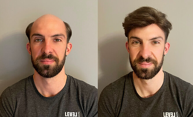 Before & after mens hairpiece