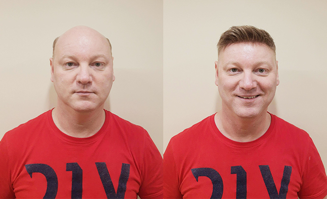 before after human hair wig photos