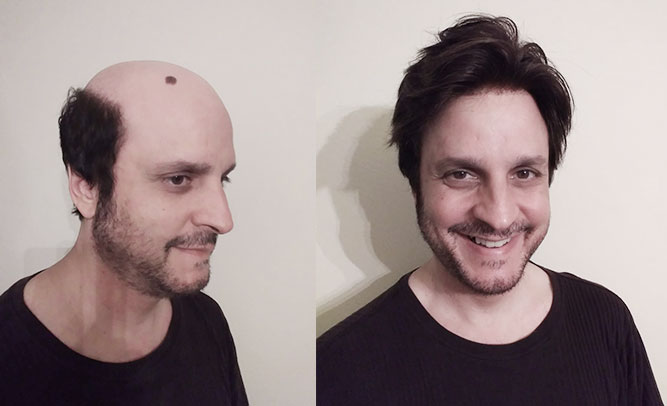 Skin toupee before after