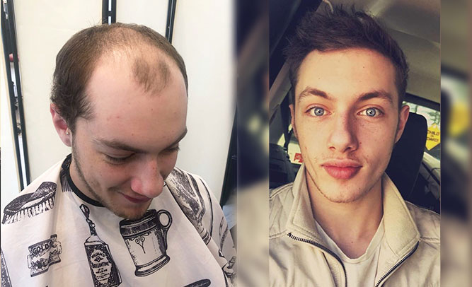 men hair toupee before after