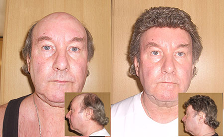Customers Photos Of Non Surgical Hair Replacement Systems