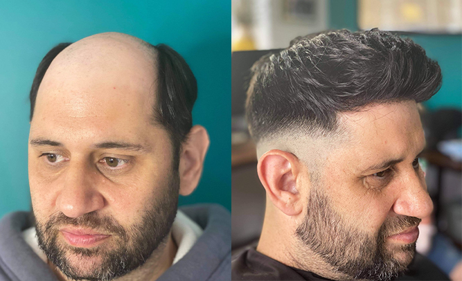 before after hair system