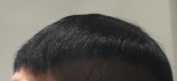 Injected Hairpieces