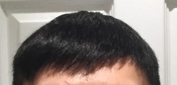 Injected Hairpieces