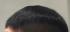 Injected Hairpieces