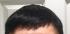 Injected Hairpieces
