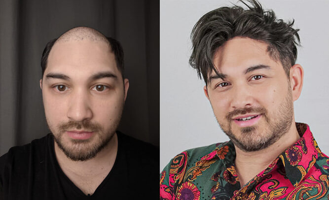 hair replacement system photo