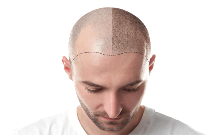 Men’s Toupees VS Hair Transplants