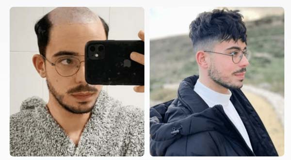 Wigs and hairpieces