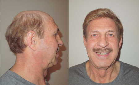 mono and skin hair system for men mono and skin hair system for men